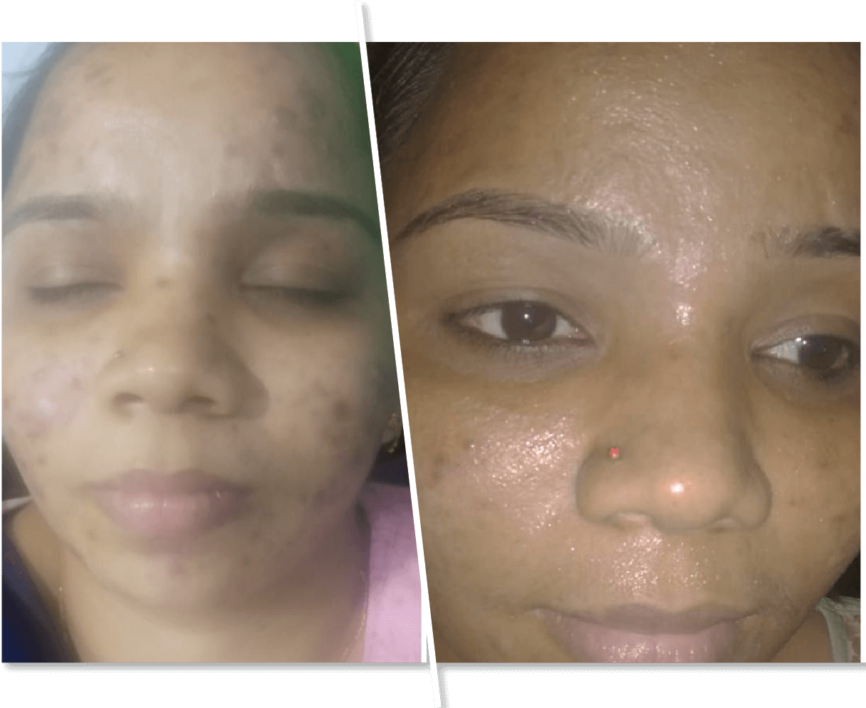 Acne Treatment Before and After Women